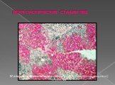 IV стадия – цирроз печени монолобулярного (микронодулярного) строения
