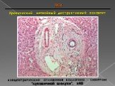 Хронический негнойный деструктивный холангит. ПСХ. концентрические отложения коллагена - симптом “луковичной шелухи”, х40