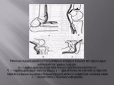 Типичные повреждения костно-суставного аппарата конечностей, при кото­рых наблюдаются травмы сосудов: а — надмыщелковый разгибательный перелом пле­чевой кости; б —- надмыщелковый перелои бедра; в — задний вывих в коленном суставе или перело-мо-вывих мыщелка большеберцовой кости со сме­щением отломко