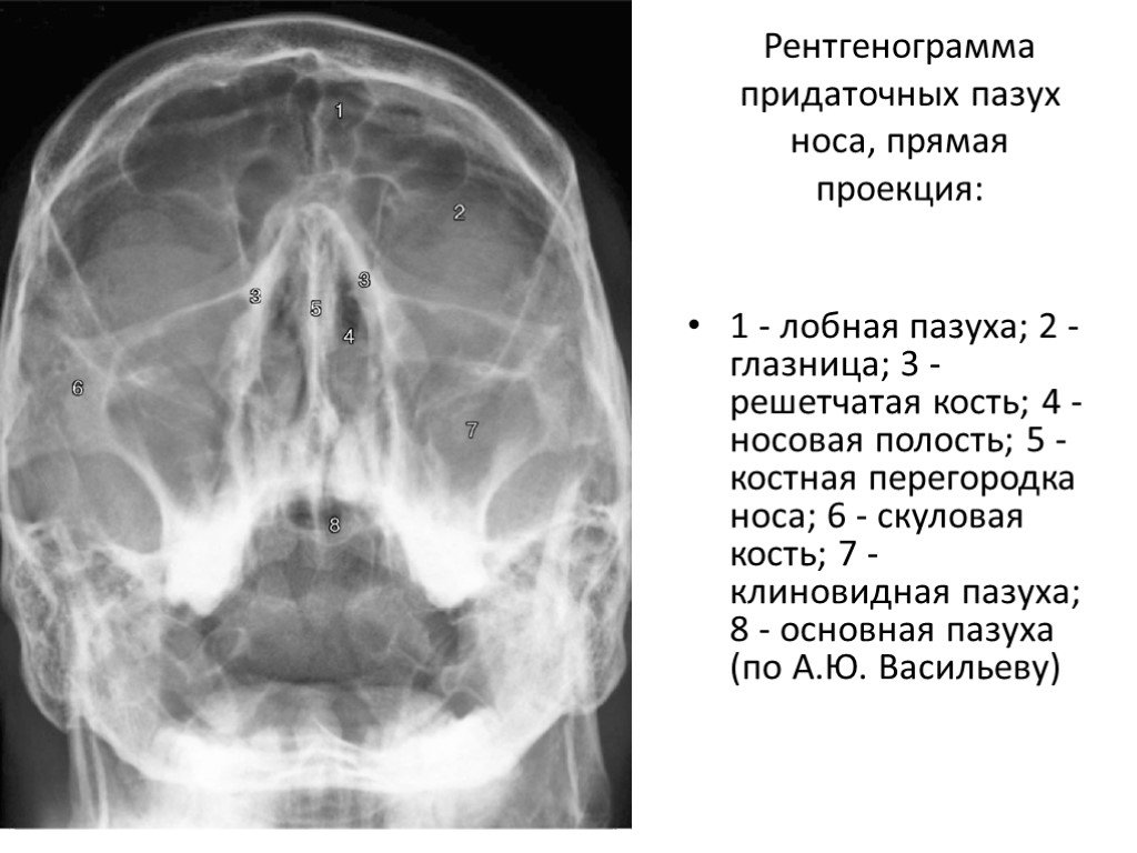 Рентген носовых. Рентгенография придаточных пазух (1 проекция). Рентген придаточных пазух носа 1 проекция. Придаточные пазухи носа рентген норма. Что такое рентген пазух носа 1 проекция.