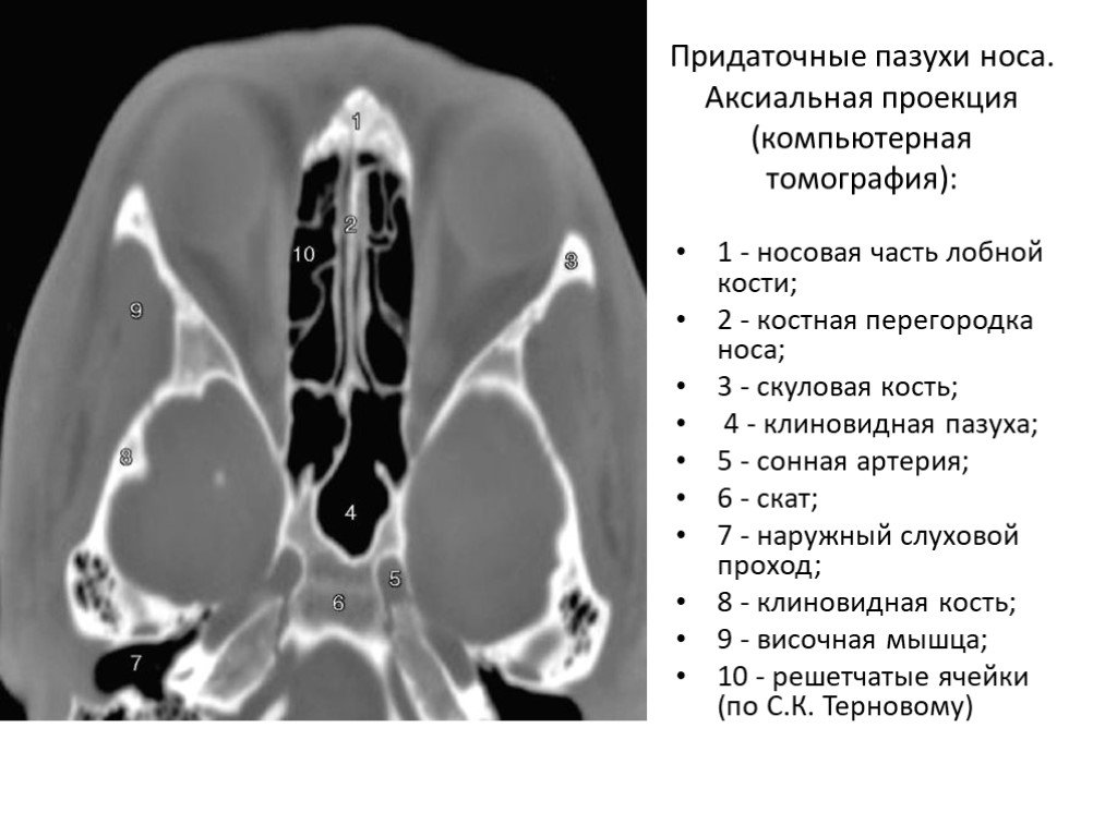 Кт околоносовых пазух картинки