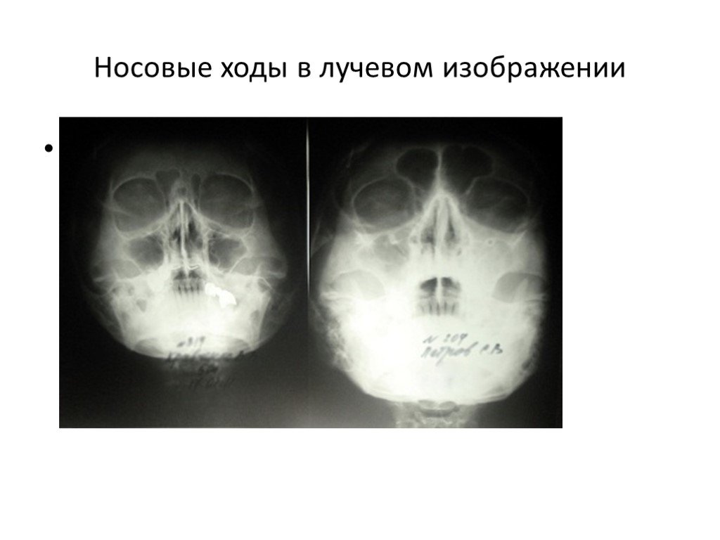 Носовые ходы. Носовые проходы сужены. Сужение носовых ходов рентген.