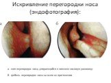 Искривление перегородки носа (эндофотография): а - шип перегородки носа, упирающийся в нижнюю носовую раковину; б - гребень перегородки носа на всем ее протяжении