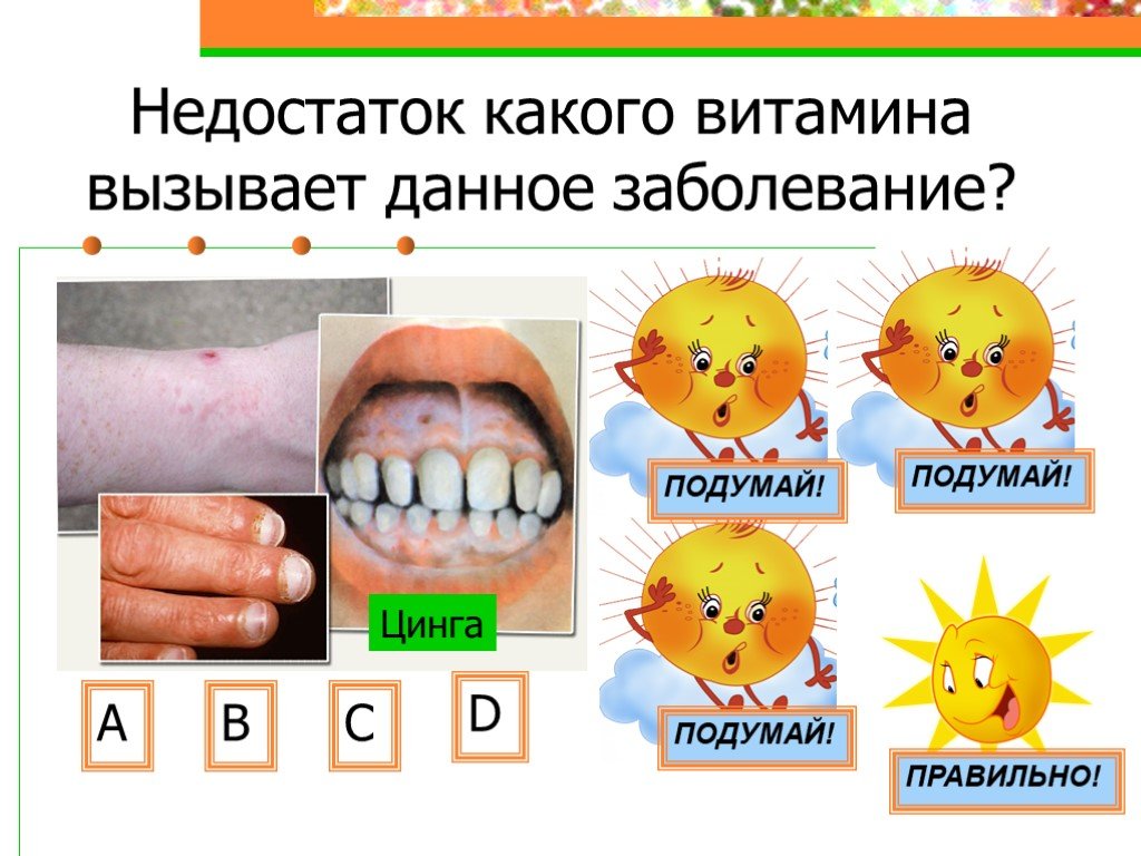 Витамина какая болезнь. Цинга (дефицит витамина с). Цинга недостаток витамина.