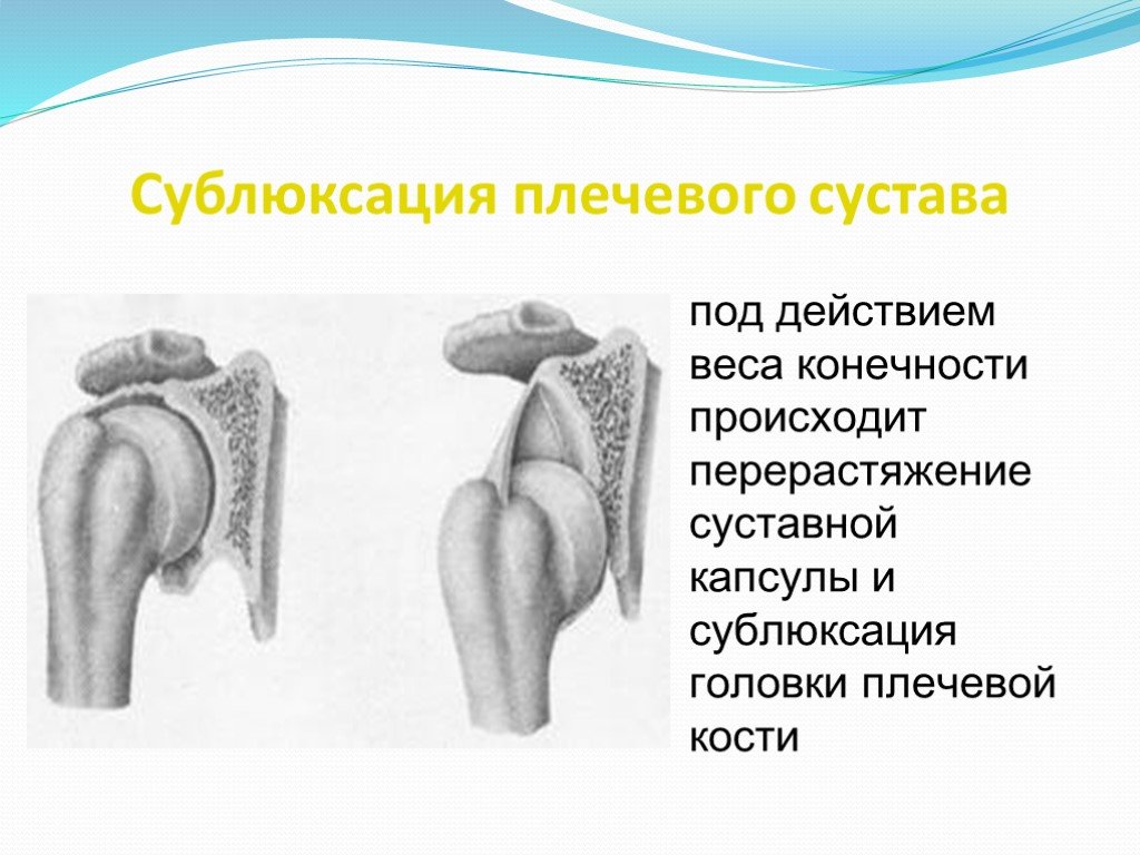 Первичный вывих плечевого сустава карта вызова