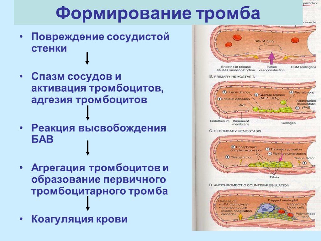 Развития тромбов. Стадии образования тромба при повреждении сосуда. Опишите процесс образования тромба.. Образование кровяного сгустка схема. Схема формирования тромба.