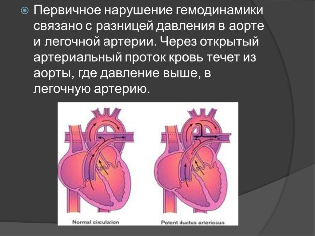 Оап у новорожденных. Открытый артериальный (боталлов) проток (ОАП). Открытый артериальный проток (ОАП). Открытый артериальный проток нарушение гемодинамики. Открытый артериальный проток боталлов проток.