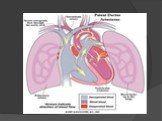 Открытый артериальный (боталлов) проток сердца Слайд: 17
