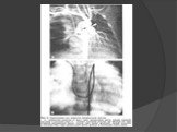Открытый артериальный (боталлов) проток сердца Слайд: 24