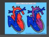 Открытый артериальный (боталлов) проток сердца Слайд: 6