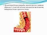 Дизентерийные микробы локализуются главным образом в толстой кишке, вызывая ее воспаление, поверхностные эрозии и язвы.