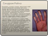 Синдром Рейно. В основном у молодых женщин, представляет собой феномен трёхфазного изменения цвета кожи пальцев рук, реже рук и ног (в отдельных случаях кончика носа, губ, кончика языка, ушных раковин), обусловленный симметричным пароксизмальным вазоспазмом. В первой фазе отмечается побледнение кожи
