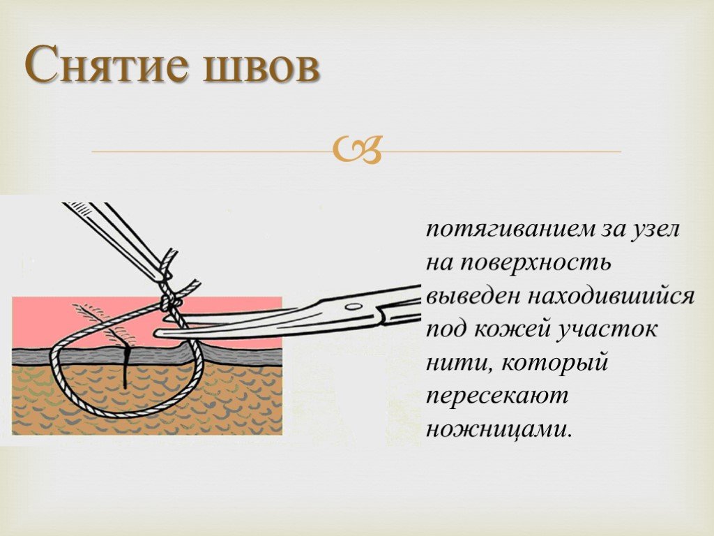 Через сколько дней снимают. Алгоритм снятия швов хирургия. Снятие узлового кожного шва.