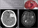 Крупные гематомы в определенных учас- тках мозга могут явиться причиной смер- ти больного, а также существенно повли- ять на качество жизни после относитель- ного выздоровления.