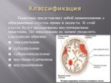 Классификация. Гематома представляет собой кровоизлияние с образованием сгустка крови в полости. В этой статье будут рассмотрены внутричерепные гематомы. По локализации их можно разделить следующим образом: эпидуральные субдуральные субарахноидальные внутрижелудочковые внутримозговые