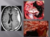 Гематомы головного мозга Слайд: 6
