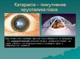 Катаракта – помутнение хрусталика глаза. Единственный, наиболее верный путь избавления от катаракты - это хирургический, который сегодня усовершенствован до такой степени, что операцию можно проводить даже в амбулаторных условиях.