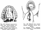 Клинико-анатомическое обоснование проводниковой анестезии                               ( туберальной, подглазничной, резцовой, небной) на верхних зубах Слайд: 11