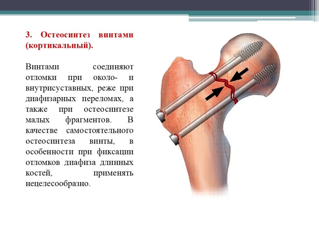 Лечение трещины кости