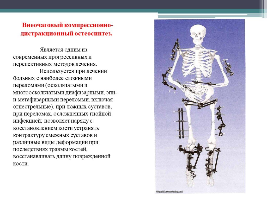 Внеочаговый остеосинтез презентация