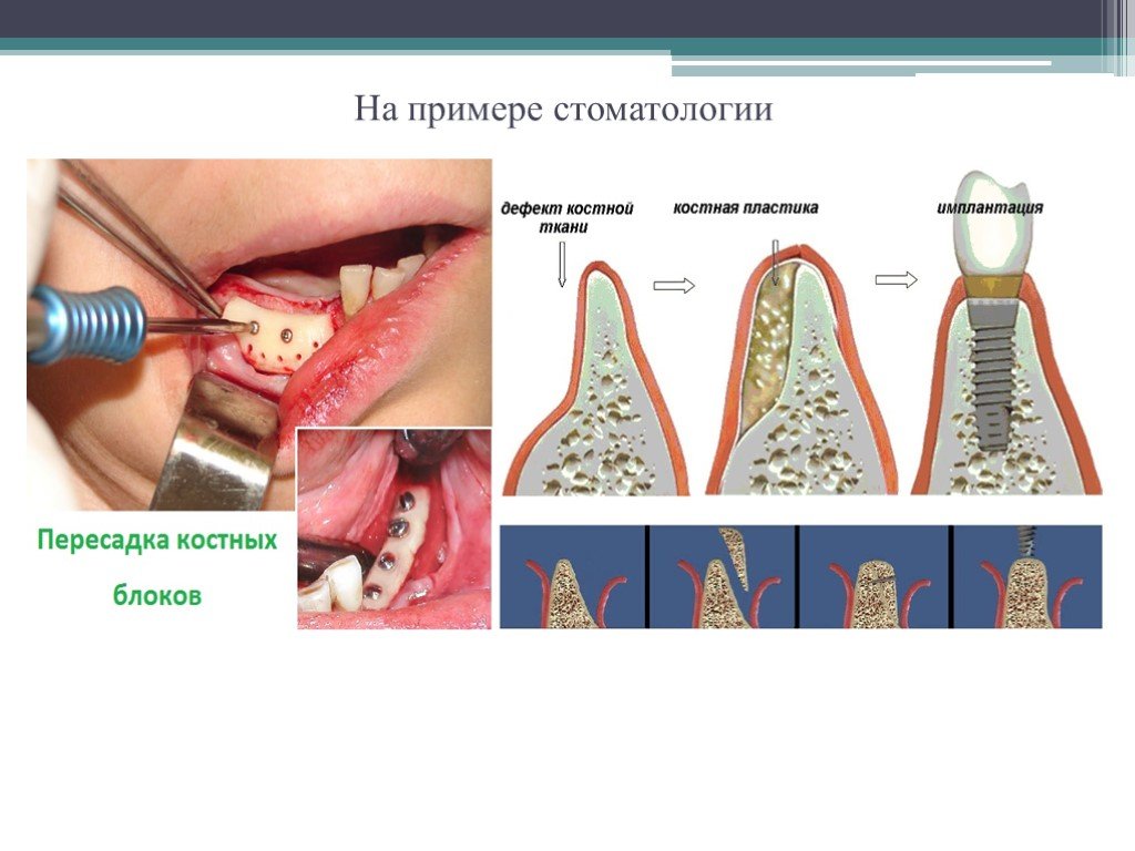 Костная пластика презентация