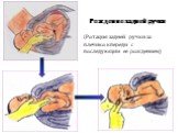 Рождение задней ручки (Ротация задней ручки за плечико кпереди с последующим ее рождением)