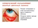 Резкая гиперемия и отек конъюнктивы век и глазного яблока Рисунок желез хряща (мейбомиевых) стушеван
