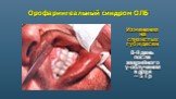 Орофарингеальный синдром ОЛБ. Изменения на слизистых губ и десен 8-й день после аварийного γ-облучения в дозе ~ 5 Гр