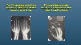 Рентгенограмма кистей рук больного с МЛП III степени тяжести через 1 год. Рентгенограмма левой кисти того же больного еще через 1 год 8 месяцев