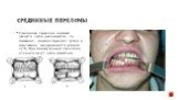 Срединные переломы. Срединные переломы нижней челюсти легко распознаются по смещению нижних передних зубов и нарушению непрерывности зубной дуги. При бимануальной пальпации отломки могут легко смещаться.