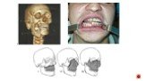 классификация переломов верхней и нижней челюсти Слайд: 2