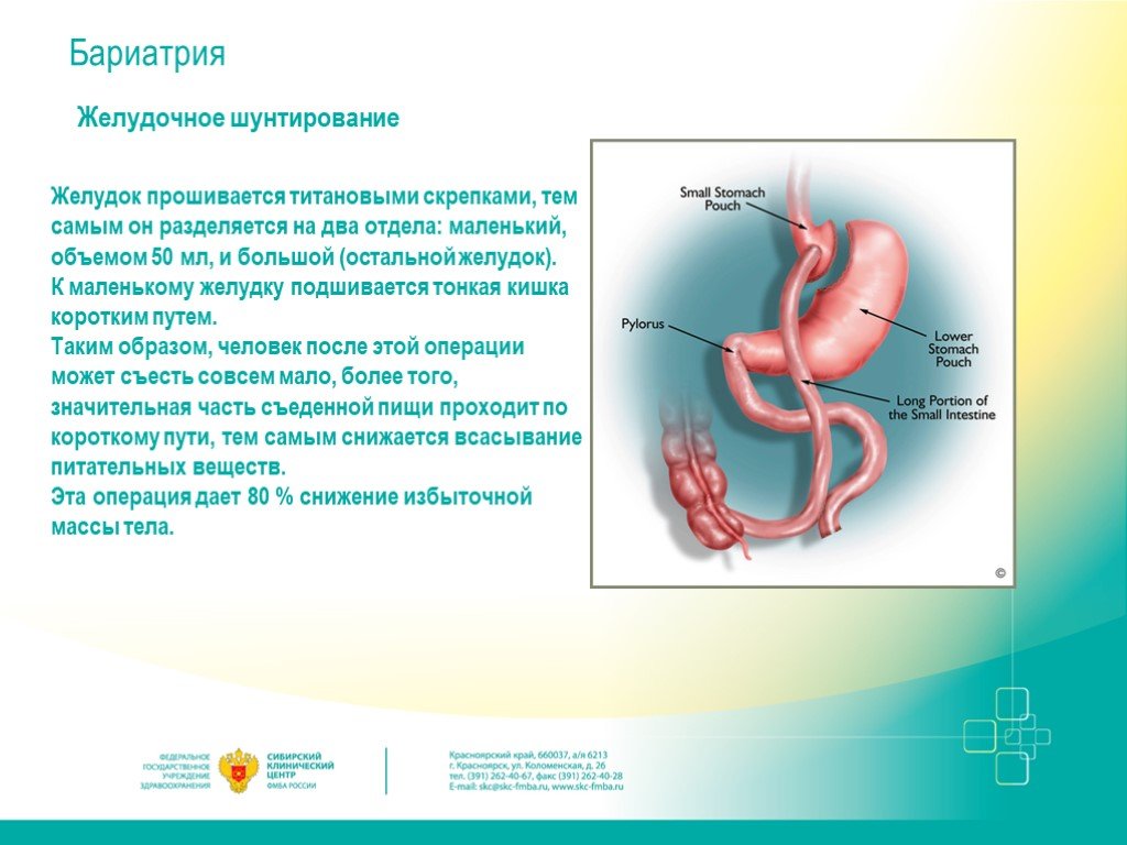Желудок отзывы. Бариатрическое шунтирование желудка. Бариатрическая операция шунтирование. Бариатрическая шунтирование желудка. Бариатрия операция желудок.
