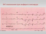 3. подъем сегмента S-T выше изолинии в отведениях, расположенных над областью инфаркта. 4. дискордантное смещение сегмента S-T ниже изолинии в отведениях, противоположных области инфаркта.