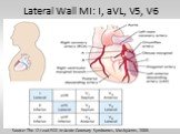 Lateral Wall MI: I, aVL, V5, V6. Source: The 12-Lead ECG in Acute Coronary Syndromes, MosbyJems, 2006.