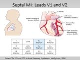 Septal MI: Leads V1 and V2