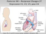 Posterior MI – Reciprocal Changes ST Depression V1, V2, V3, poss V4