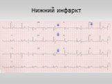 ЭКГ-диагностика при подозрении на инфаркт миокарда Слайд: 35