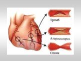 ЭКГ-диагностика при подозрении на инфаркт миокарда Слайд: 8
