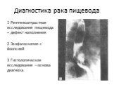 Диагностика рака пищевода. 1 Рентгенконтрастное исследование пищевода – дефект наполнения 2 Эзофагоскопия с биопсией 3 Гистологическое исследование – основа диагноза.