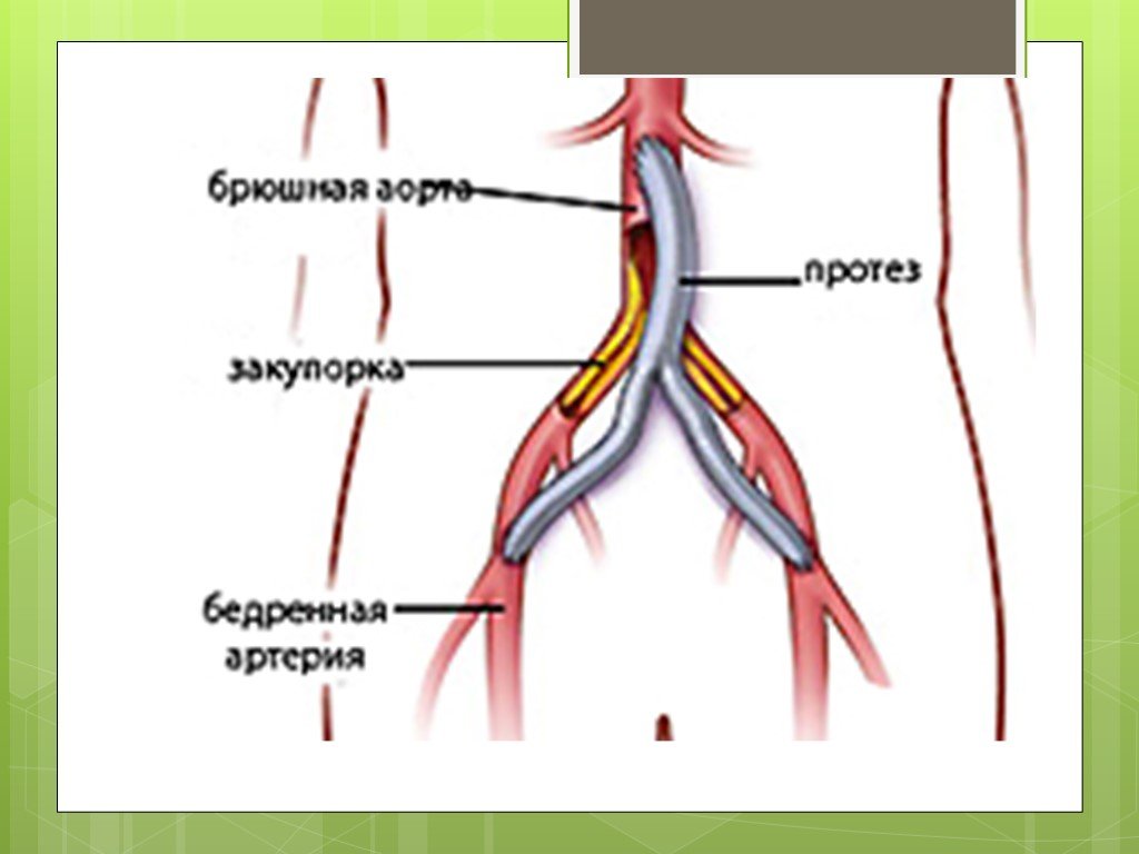 Артерия ноги операция. Бифуркационное аорто-бедренное шунтирование. Аорто бедренная и подколенная шунтирование. Бифуркационное аорто-бедренное шунтирование ход операции. Аорто брюшное шунтирование.