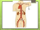 Атеросклеротическое поражение артерий. Облитерирующий эндартериит Слайд: 19