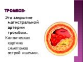 Тромбоз-. Это закрытие магистральной артерии тромбом. Клиническая картина симптомов острой ишемии.