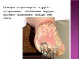 Исходом атеросклероза и других артериальных заболеваний нередко является омертвение пальцев или стопы