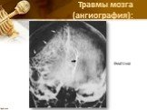 Травмы мозга (ангиография): Гематома