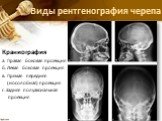 Виды рентгенография черепа. Краниография а. Правая боковая проекция б. Левая боковая проекция в. Прямая передняя (носолобная) проекция г. Задняя полуаксиальная проекция