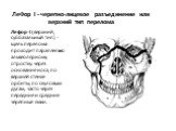 ЛеФор I - черепно-лицевое разъединение или верхний тип перелома. Лефор-I (верхний, суббазальный тип) -щель перелома проходит параллельно альвеолярному отростку: через основание носа, по верхней стенке орбиты, по скуловым дугам, часто через передние и средние черепные ямки.