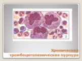 Хроническая тромбоцитопеническая пурпура