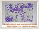 Периферическая кровь при ХМЛ: лейкоцитоз со сдвигом влево