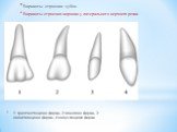 1- трапециевидная форма, 2-овальная форма, 3- ланцетовидная форма, 4-конусовидная форма. Варианты строения зубов. Варианты строения коронки у латерального верхнего резца