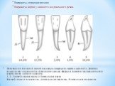 Пунктиром и сплошной линией показаны возможные положения корня зуба. Линии на поверхностях коронок зубов обозначают их рельеф. Цифры (в процентах)указывают частоту встречаемости данного варианта. 1, 2, 3-вестибулярная норма, 4, 5-мезиальная норма В-вестибулярная поверхность, Д-дистальная поверхность
